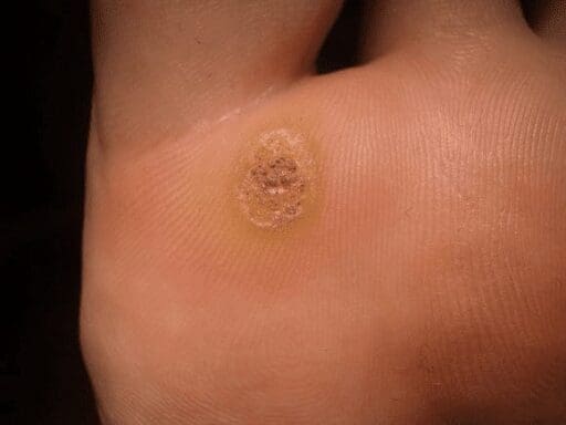 warts