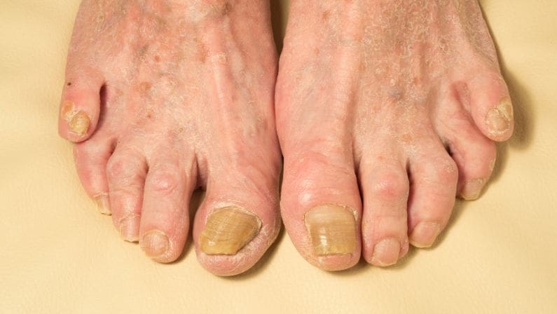 Fungal Nail